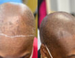 scalp micropigmentation