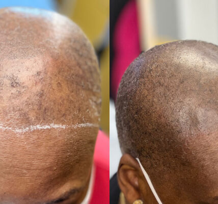 scalp micropigmentation