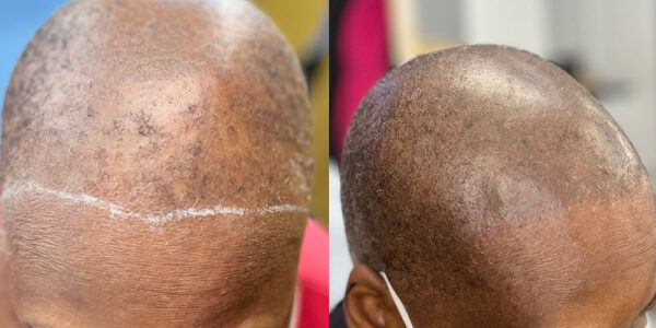 scalp micropigmentation