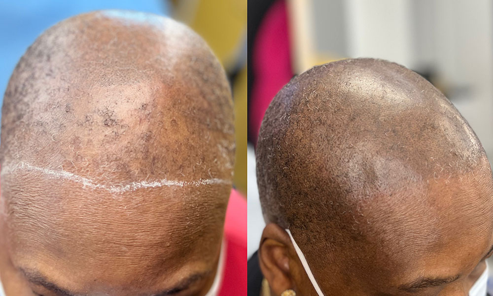 scalp micropigmentation